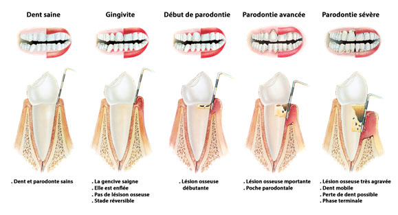 parodondie 1