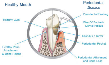 parodontie en