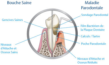 parodontie